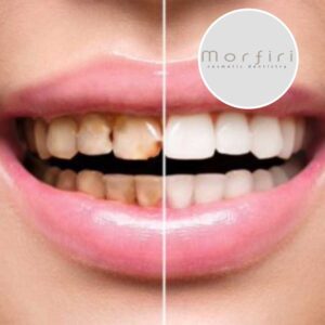 Cosmetic Bonding Η απόδοση του χρώματος είναι απόλύτως συμβατή με το φυσικό χρώμα των δοντιών μας